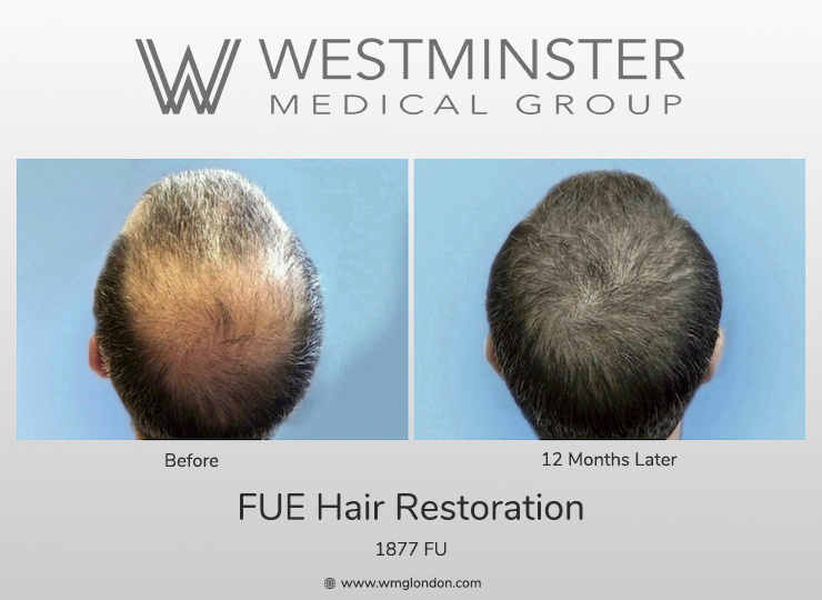WMG Crown Restoration.jpg