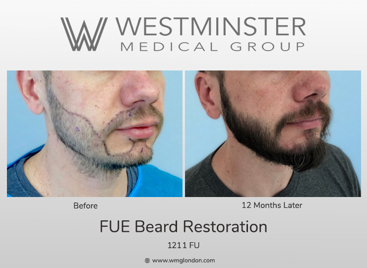 WMG FUE Beard.jpg