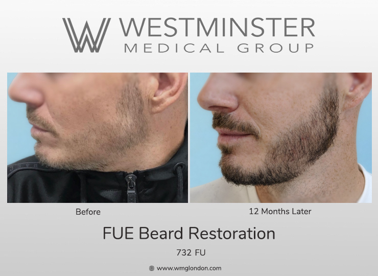 WMG FUE Beard.jpg