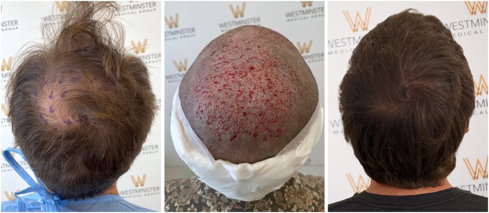 WMG FUE Crown Hair Transplant.jpg