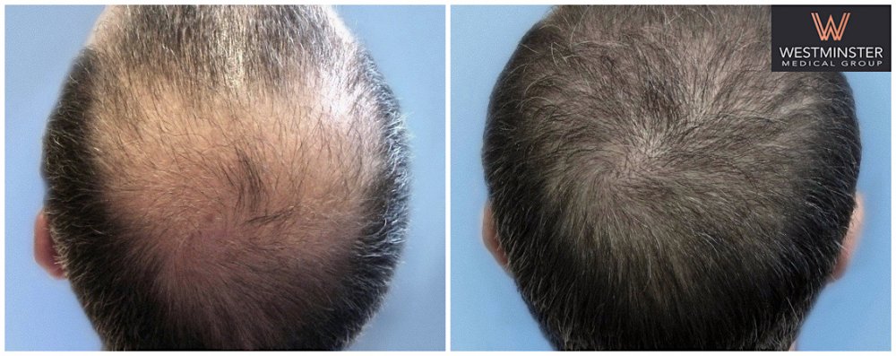 WMG FUE Crown Restoration.jpg