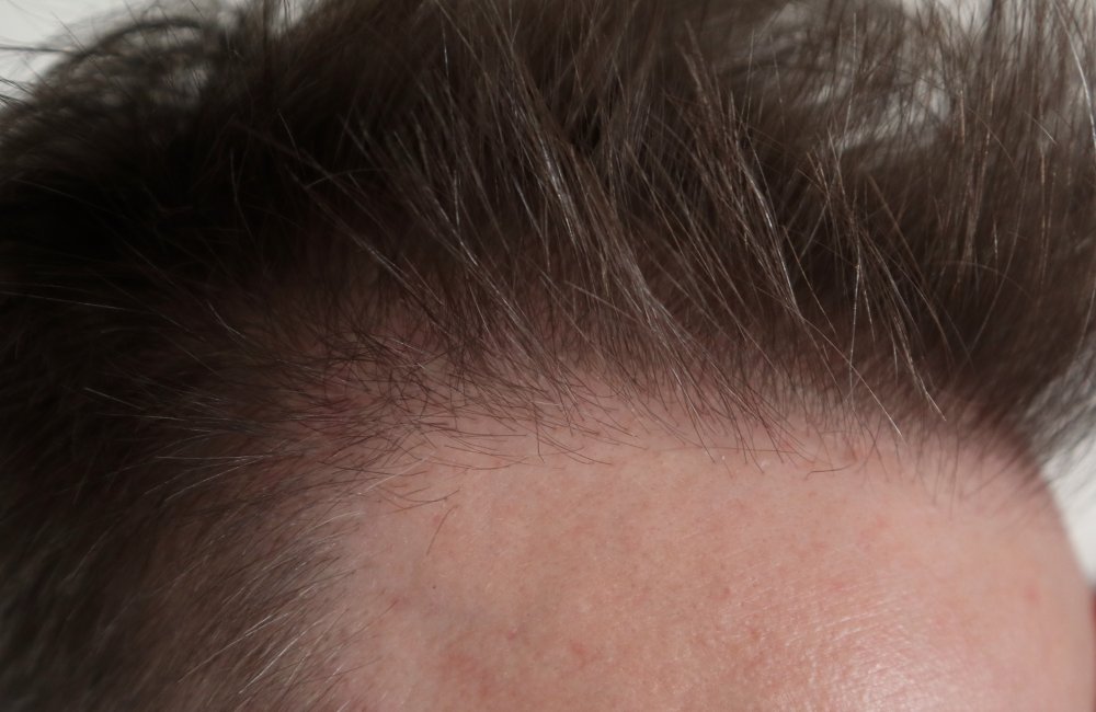 WMG FUE Hair Repair .jpg