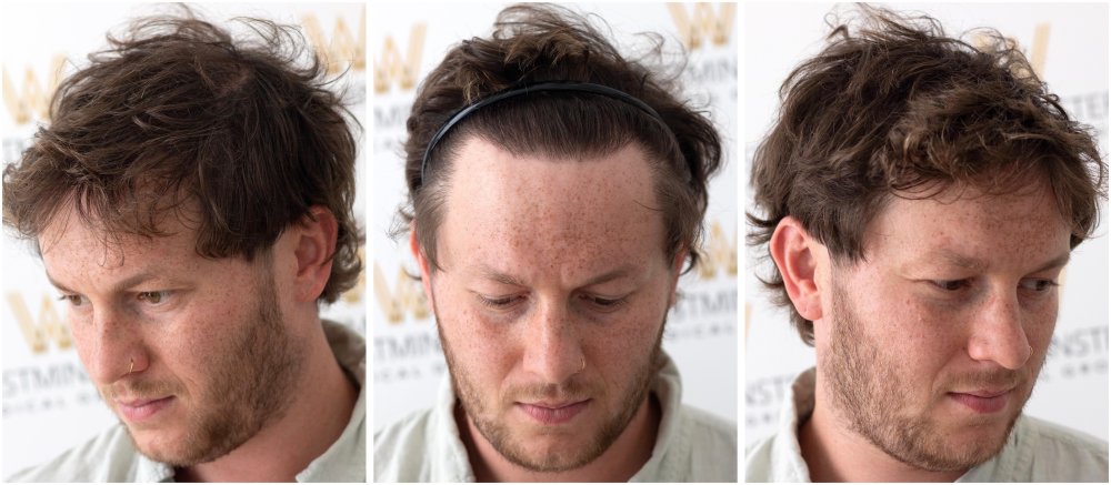 WMG FUE Hair Transplant 12 Month Result.jpg