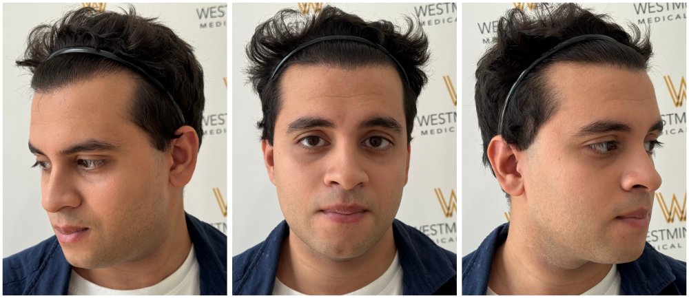 WMG FUE Hair Transplant 12 Months.jpg