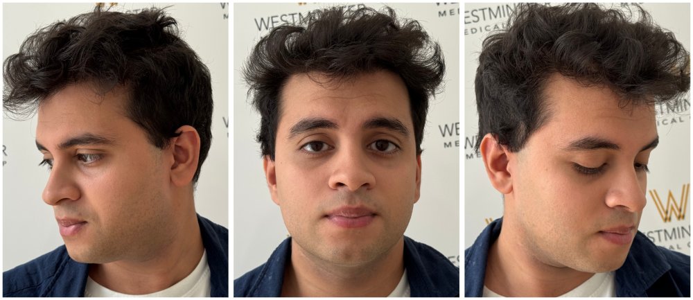 WMG FUE Hair Transplant 12 Months UK.jpg