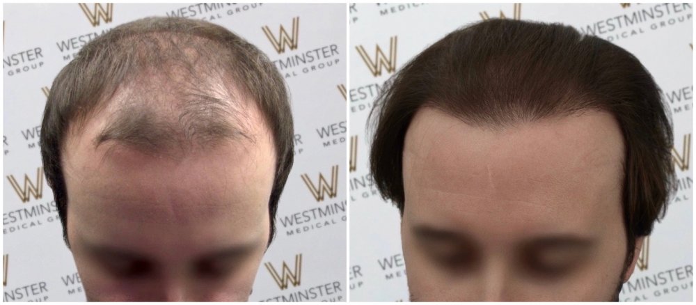 WMG FUE Hair Transplant.jpg
