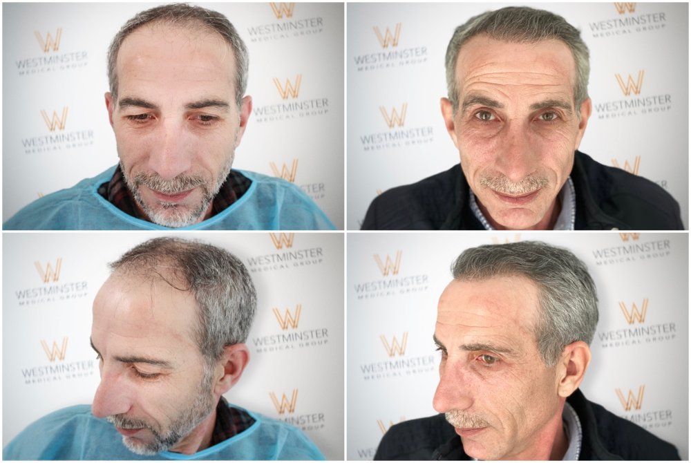 WMG FUE Hair Transplant London.jpg.jpg