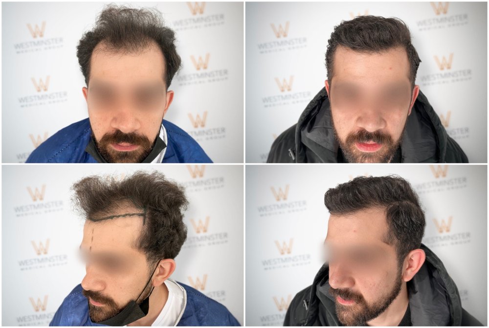 WMG FUE Hair Transplant London.jpg