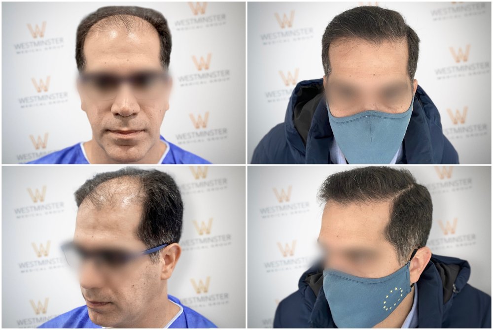 WMG FUE Hair Transplant London.jpg