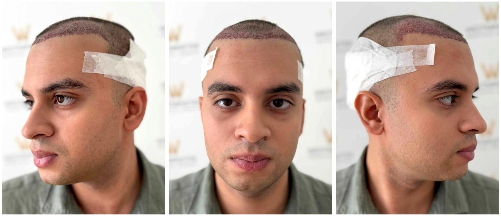 WMG FUE Hair Transplant Post Op.jpg