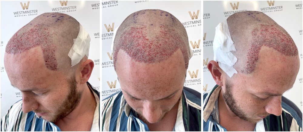 WMG FUE Hair Transplant Post Op.jpg