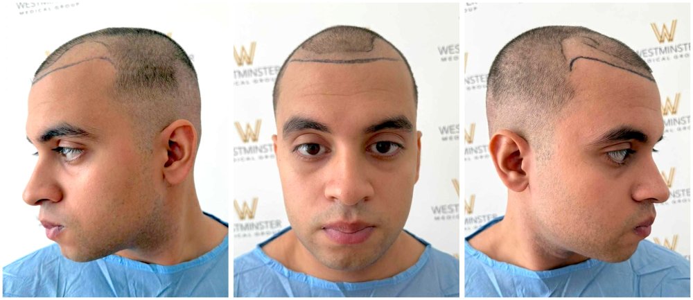 WMG FUE Hair Transplant Pre Op.jpg