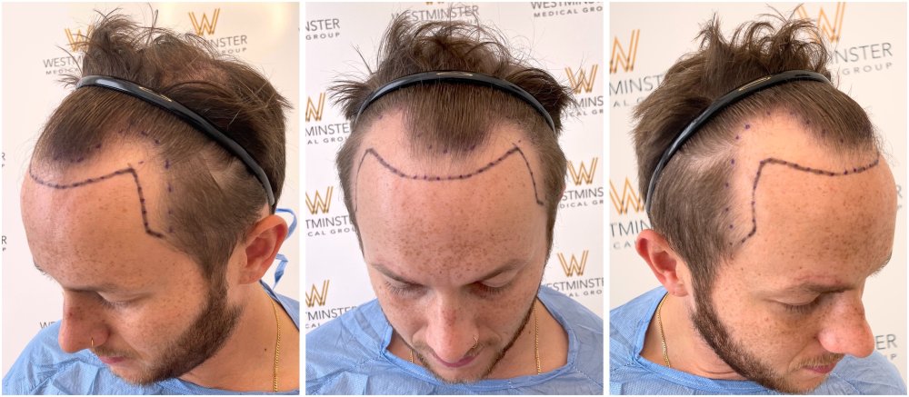 WMG FUE Hair Transplant Pre Op.jpg