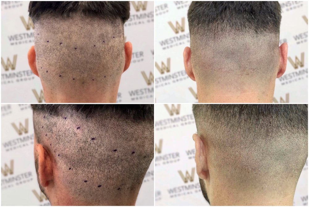 WMG FUE Scar Repair Via SMP London.jpg