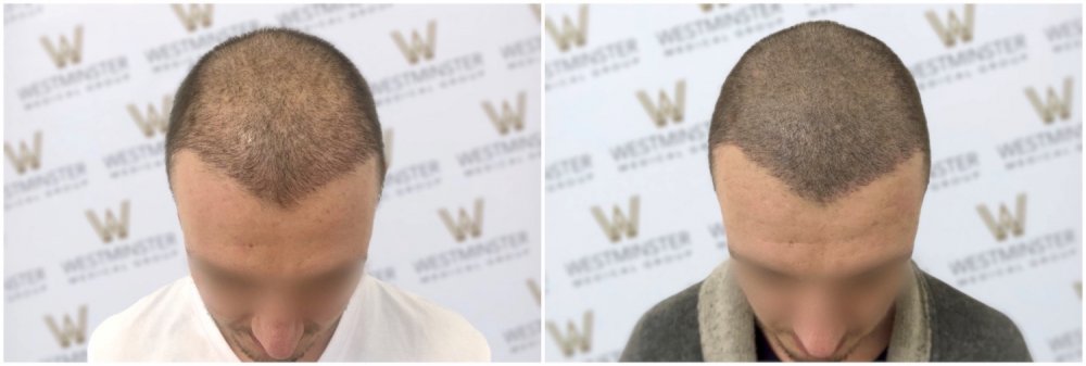 WMG Hair Transplant Repair Via SMP London.jpg