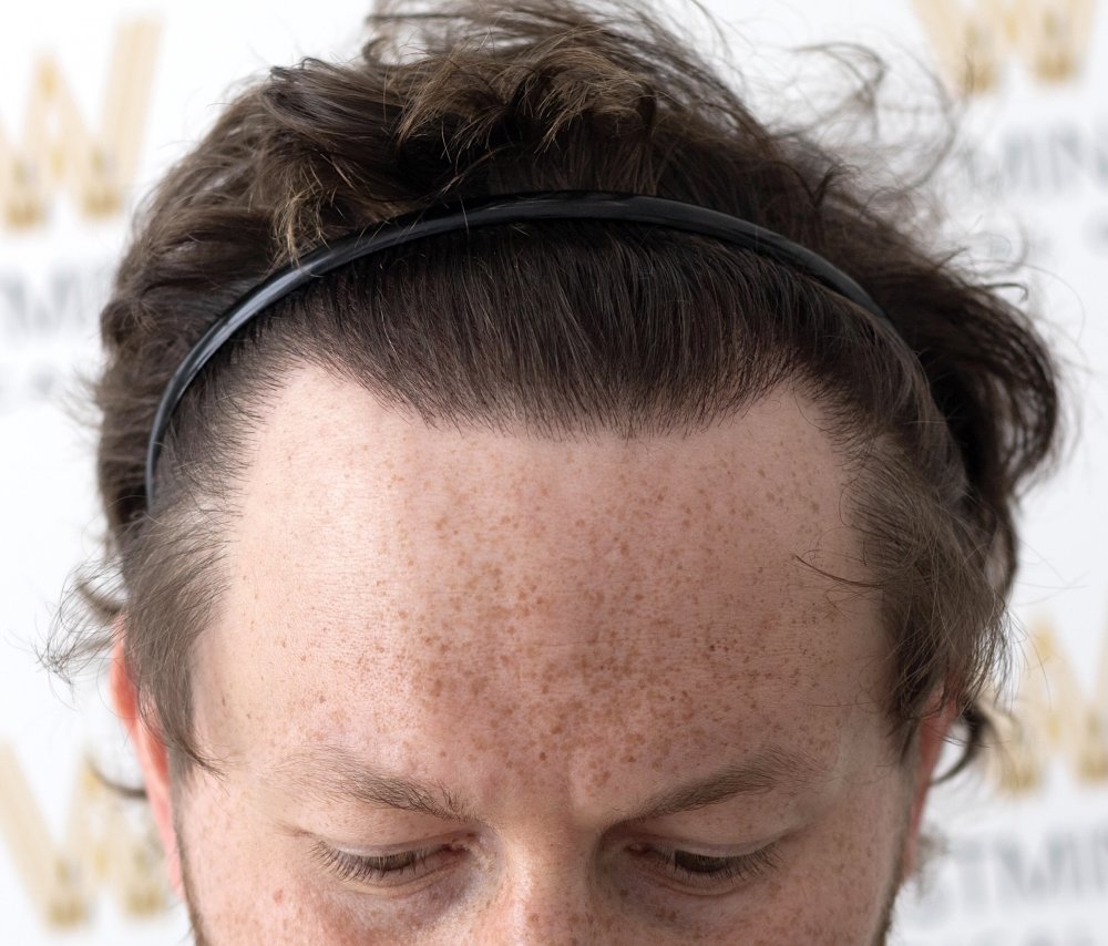 WMG Hairline close up.jpg