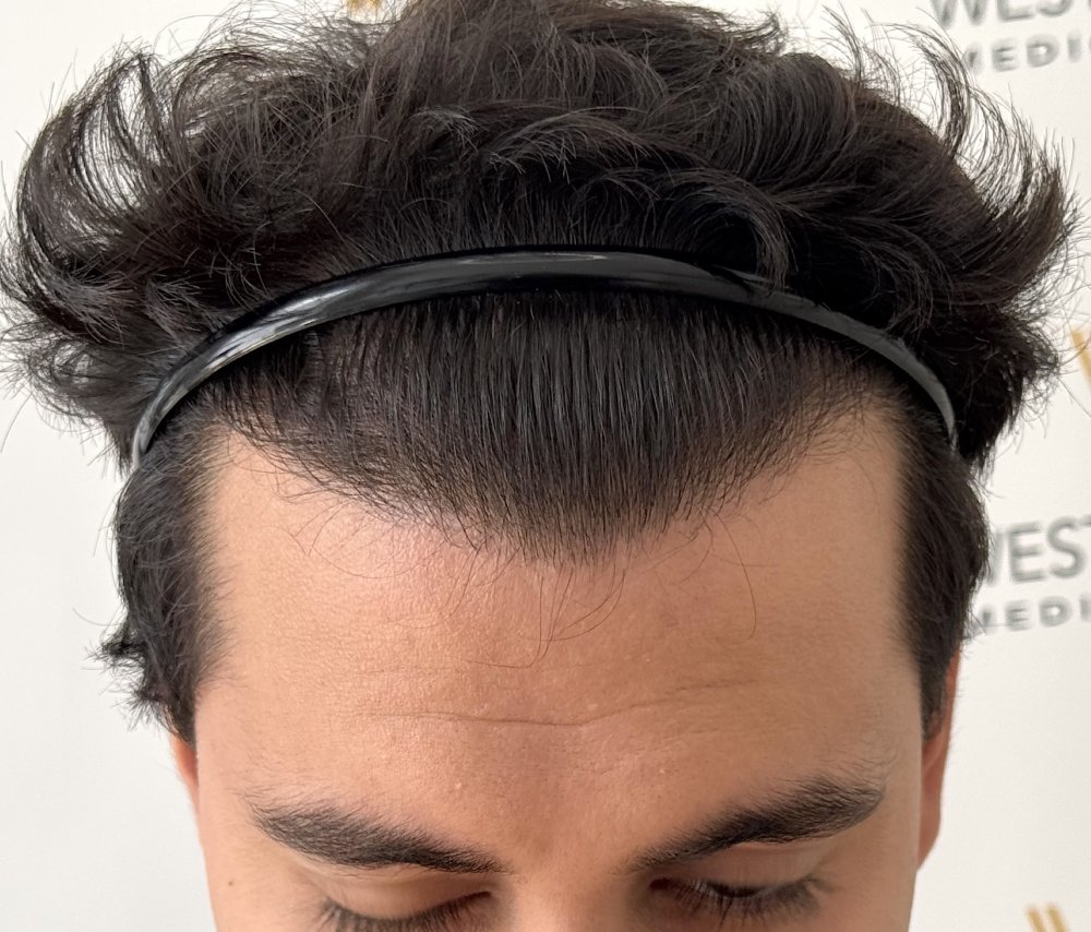 WMG Hairline close up.jpg