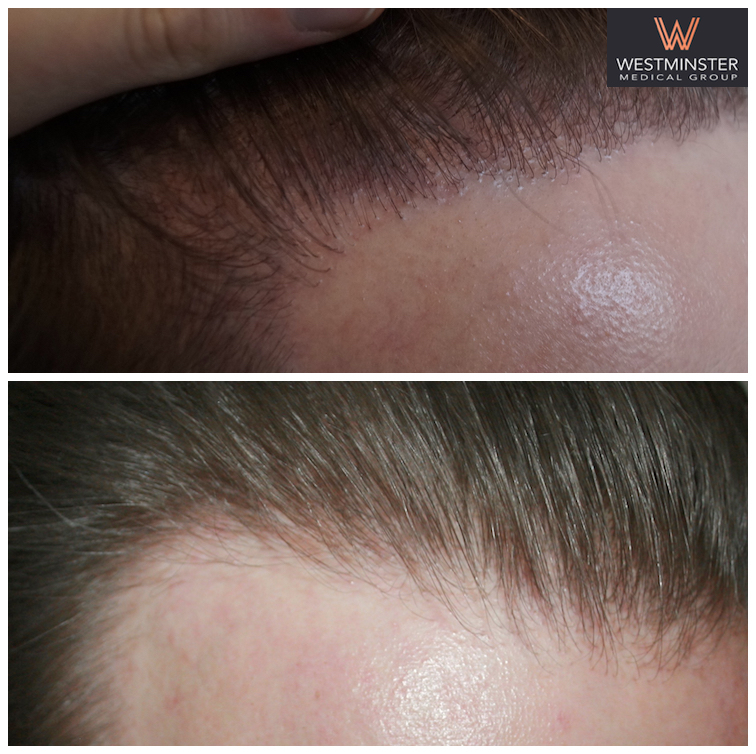 WMG Hairline Repair.jpg