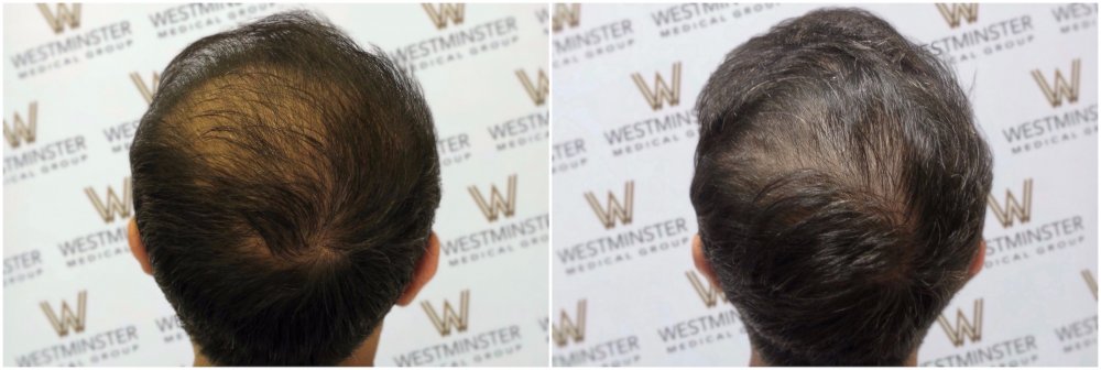 WMG London FUE Crown Restoration 1566 FU.jpg
