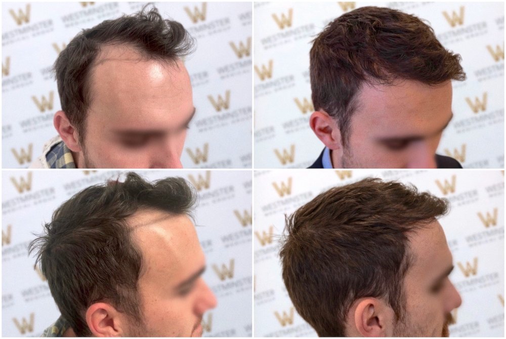 WMG London FUE Hair Transplant .jpg
