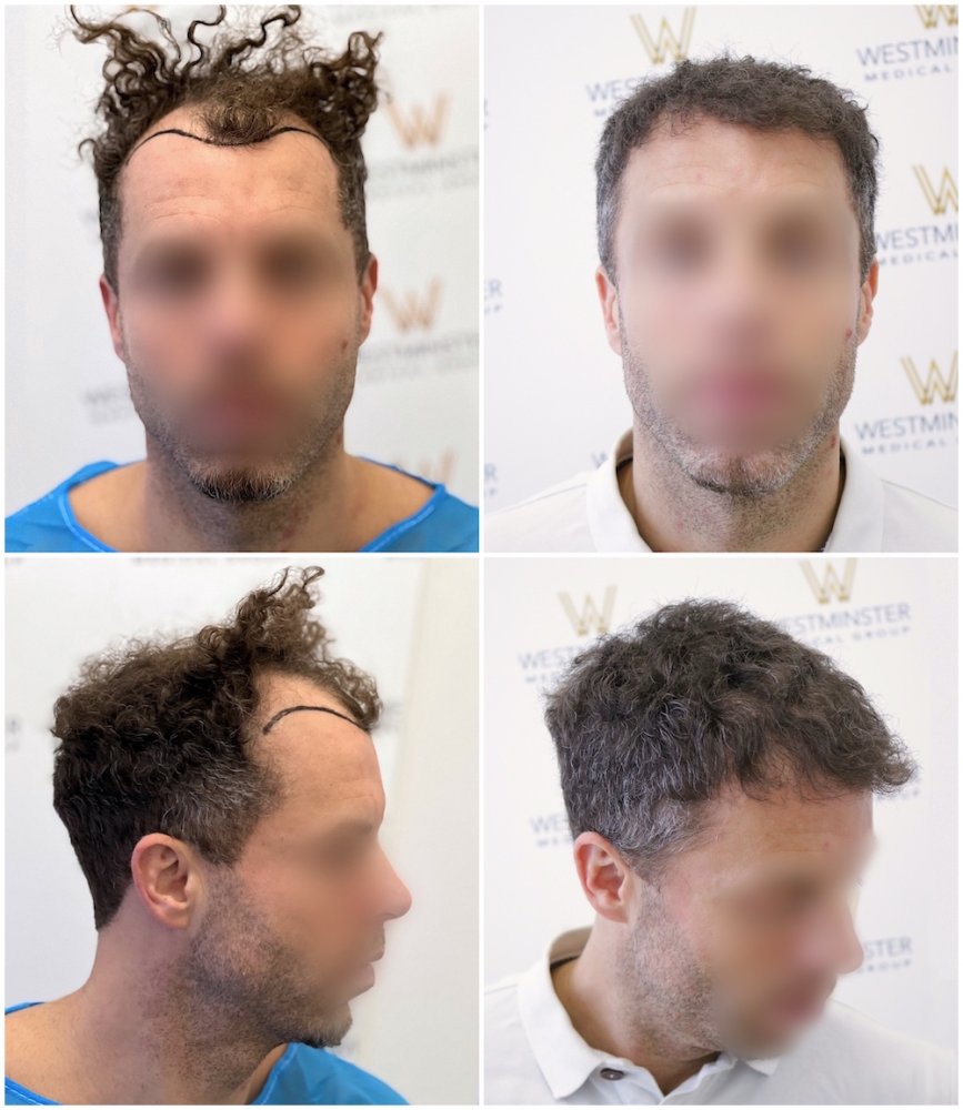 WMG-London-FUE-Hair-Transplant.jpg