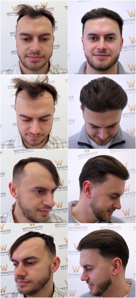 WMG-London-FUE-Hair-Transplant.jpg