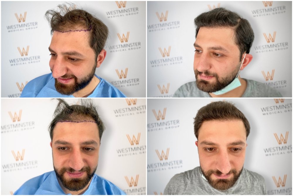 WMG London FUE Hair Transplant.jpg