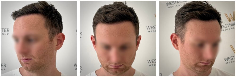WMG London FUE Hair Transplant Post Op.jpg