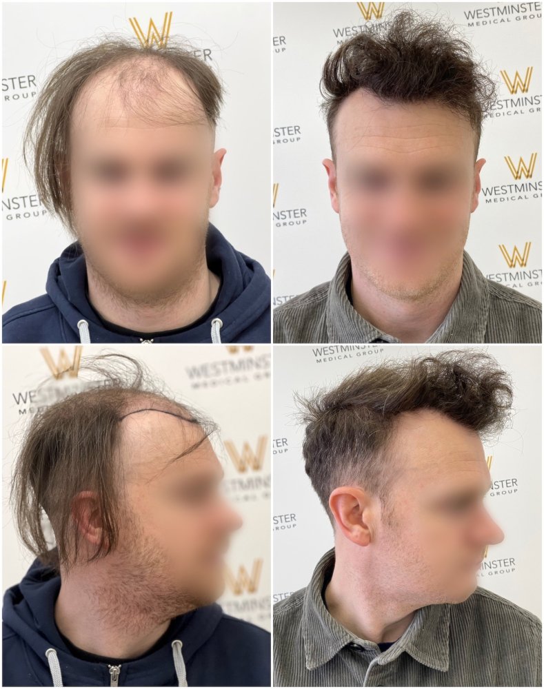 WMG-London-FUE-Hair-Transplant-UK.jpg
