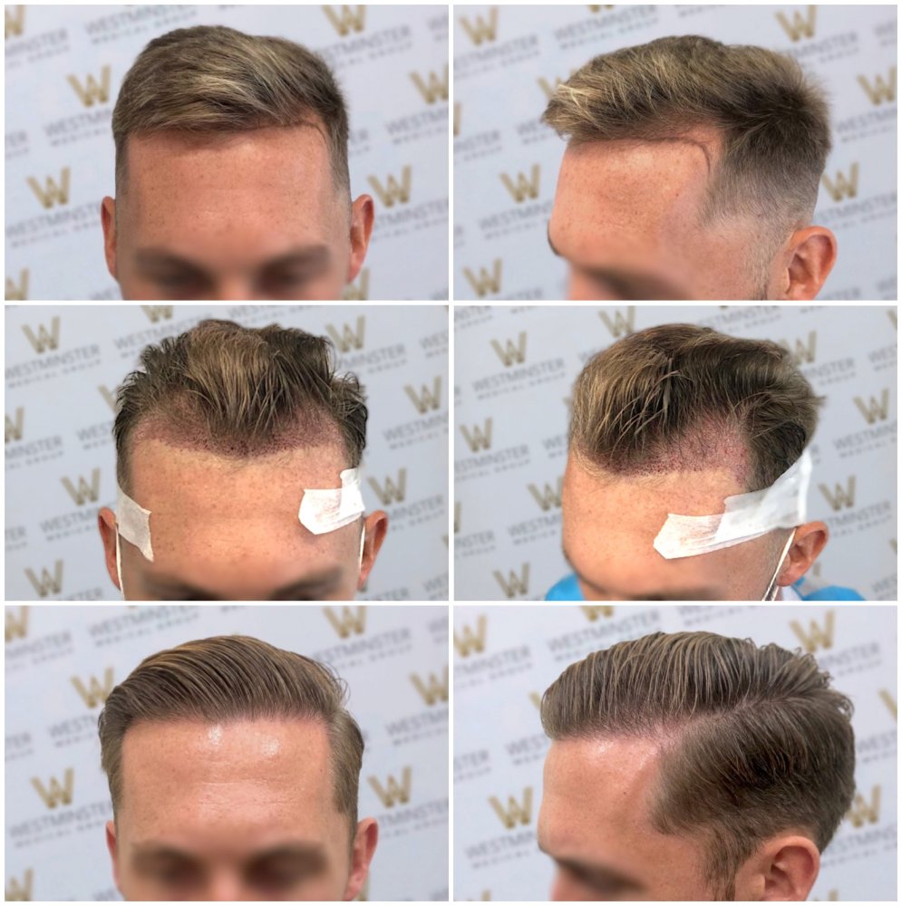 WMG London FUE Hairline Restoration .jpg