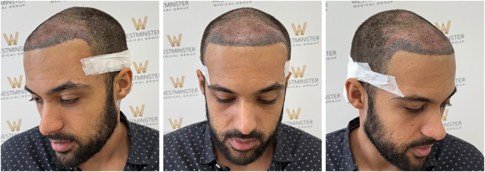 WMG London FUE Post Op.jpg