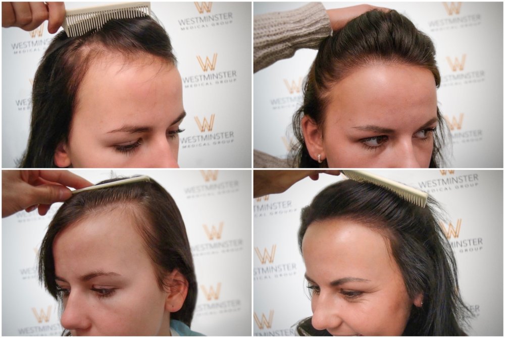 WMG London FUT Hair Transplant.jpg