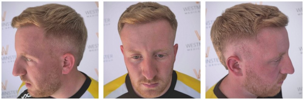 WMG London Hair Transplant 12 Month Result copy.jpg