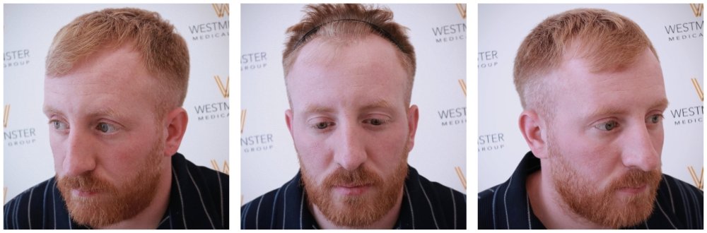 WMG London Hair Transplant Before copy.jpg
