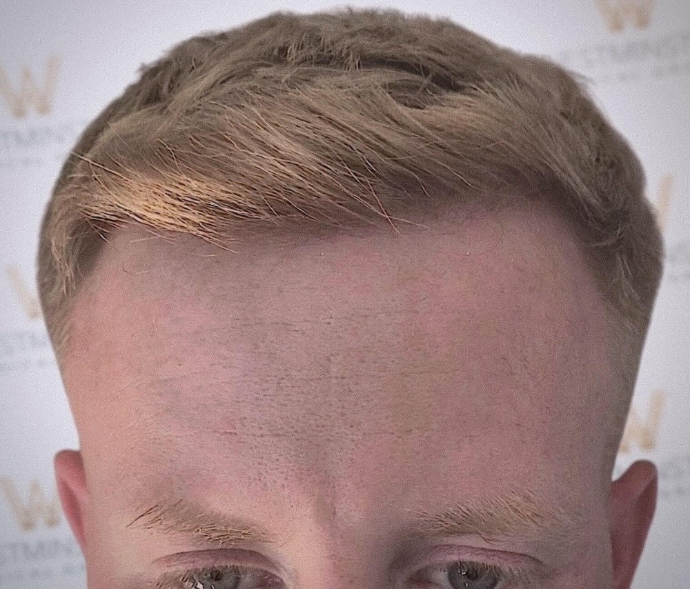 WMG-London-Hair-Transplant-Close-Up.jpg