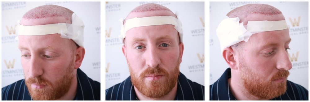 WMG London Hair Transplant Post-Op copy.jpg