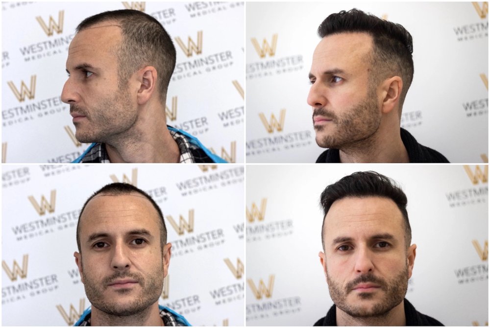 WMG London hairline FUE.jpg