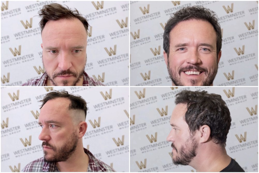 WMG-London-Robert-FUE-Hair-Transplant .jpg