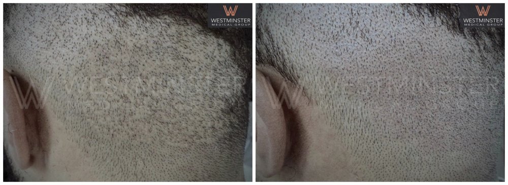 WMG SMP FUE Repair.jpg