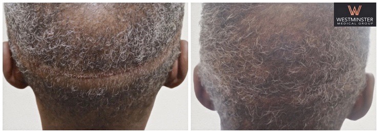 WMG Trichiogytic Closure 2.jpg