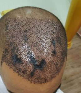 Necrosis after a hair transplant