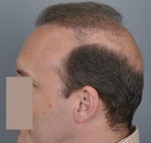 Do hair transplants last a lifetime? Do hair transplants last a lifetime?
