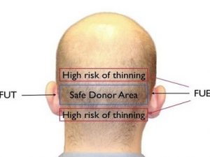Do hair transplants last a lifetime? Do hair transplants last a lifetime?