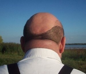 Do hair transplants last a lifetime? Do hair transplants last a lifetime?