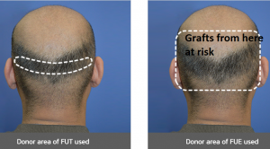 Should I get a hair transplant? What are the risks? Should I get a hair transplant? What are the risks?
