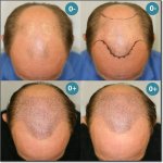 HAIR-TRANSPLANT-SURGERIES-500.jpg