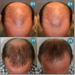HAIR-TRANSPLANT-SURGERIES-600.jpg