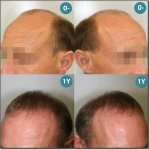 HAIR-TRANSPLANT-SURGERIES-300.jpg