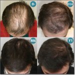 HAIR_TRANSPLANT_PATIENT-23-200.jpg