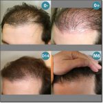 HAIR_TRANSPLANT_PATIENT-23-400.jpg
